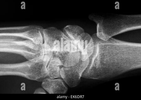 X-Ray Of Carpal And Metacarpal Bones In The Human Hand Stock Photo