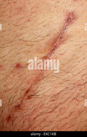 Surgery scar Stock Photo: 26064566 - Alamy