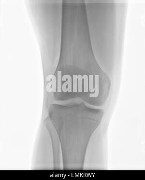 Authentic x-ray of male right knee with injured caused by sport games Stock Photo