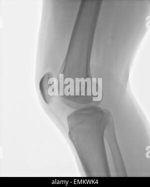 Authentic x-ray of male right knee with injured caused by sport games Stock Photo