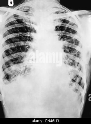 x-ray through human chest thoracic cavity showing shadow on the lung Bronchiectasis and widening of airways Stock Photo