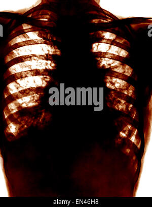 x-ray through human chest thoracic cavity showing shadow on the lung Bronchiectasis and widening of airways Stock Photo