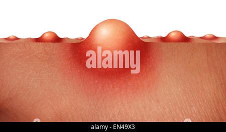 Acne skin health care concept as a group of pimples or sores on human skin as a medical anatomy symbol for a skincare epidermis Stock Photo