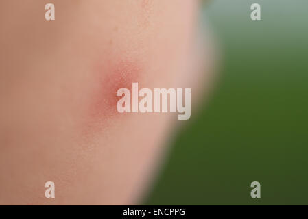 A close up shot of a mosquito bite on a young boy's cheek Stock Photo