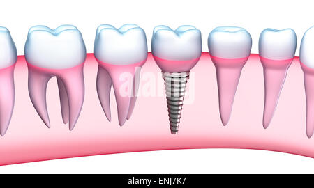 Dental Implant detailed view. 3D Illustration Stock Photo