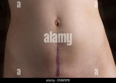 A recovering scar from a c-section operation. Stock Photo