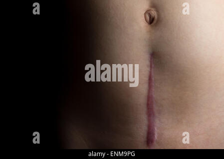 A recovering scar from a c-section operation dramatically faded to black. Stock Photo
