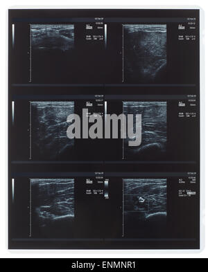 X-ray, muscle ultrasound Stock Photo