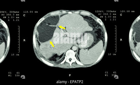 CT scan of upper abdomen : show abnormal mass at liver ( Liver cancer ) Stock Photo