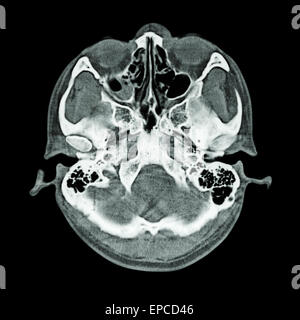 CT scan of brain and base of skull  ( Bone window ) Stock Photo
