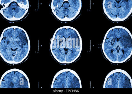 Ischemic stroke : ( CT of brain show cerebral infarction at left frontal - temporal - parietal lobe ) ( nervous system backgroun Stock Photo
