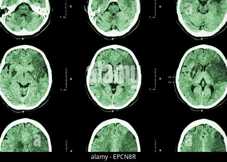 Ischemic stroke : ( CT of brain show cerebral infarction at left frontal - temporal - parietal lobe ) ( nervous system backgroun Stock Photo