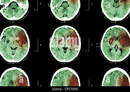 Ischemic stroke : ( CT of brain show cerebral infarction at left frontal - temporal - parietal lobe ) ( nervous system backgroun Stock Photo