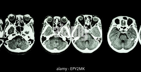 CT scan of brain and base of skull ( show structure of eye , ethmoid sinus , cerebellum , cerebrum, etc ) Stock Photo