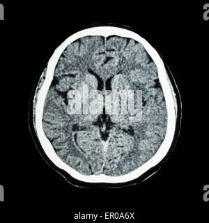 CT scan of brain : show normal human 's brain ( CAT scan ) Stock Photo