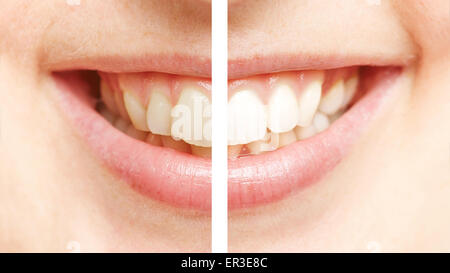 Comparison between white teeth after bleaching and before teeth whitening Stock Photo