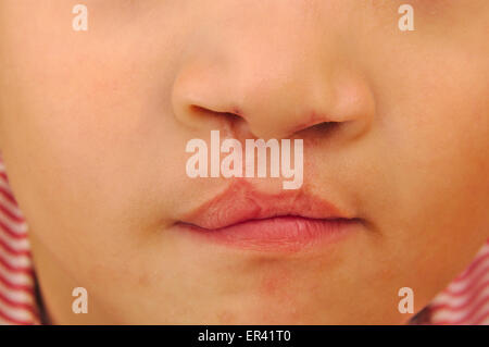 Boy showing a bilateral cleft lip repaired Stock Photo