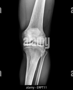 Normal knee. Frontal X-ray of the healthy left knee of a 28 year old. Stock Photo