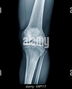 Normal knee. Frontal X-ray of the healthy left knee of a 28 year old ...