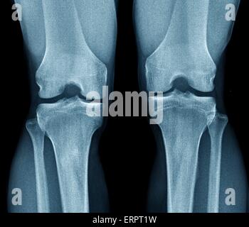 Normal knees. Frontal X-ray of the healthy knees of a 28 year old. Stock Photo