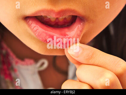 Close up of a girl with aphthous stomatitis in her lip Stock Photo