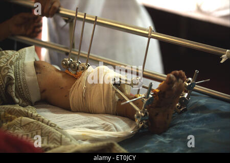 Injured foot of a victim of terrorist attack by Deccan Mujahedeen on 26th November 2008 treated in J.J. hospital in Bombay Stock Photo