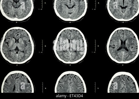 CT scan of brain show normal brain ( Neurological background ) Stock Photo