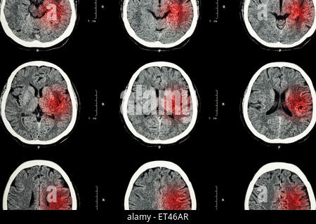 CT scan of brain with red area ( Imaging for hemorrhagic stroke or ...