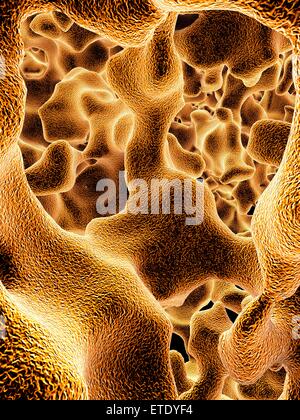 Osteoporosis. Computer artwork of the trabeculae in the cancellous (spongy) bone tissue affected by osteoporosis. The cancellous tissue fills the interior of the bones and in osteoporosis its density decreases, increasing the brittleness of the bones and Stock Photo