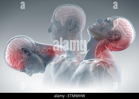 Conceptual illustration showing the stages of motion that cause whiplash: retraction, extension and rebound. Stock Photo