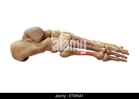 Illustration showing the bones of the foot with a break in a metatarsal highlighted. Stock Photo