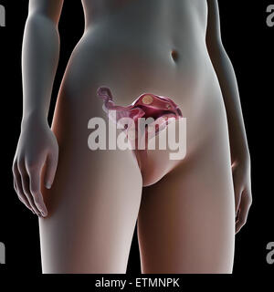 Cross section illustration showing uterine fibroids, benign tumors in the uterus. Stock Photo