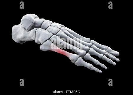 Illustration showing the bones of the foot with a break in a metatarsal highlighted. Stock Photo