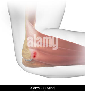 Illustration of the arm with transparent skin to show injury to the lateral epicondyle tendon, known as lateral epicondylitis or tennis elbow. Stock Photo