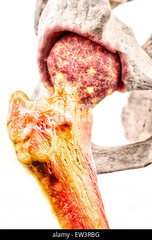 Rheumatoid arthritis of hip joint Stock Photo: 49341572 - Alamy