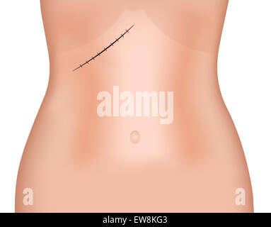 left subcostal incision