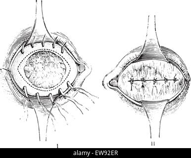 Total anterior staphyloma, vintage engraved illustration. Usual ...