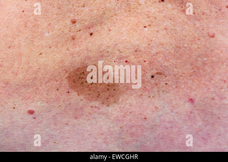Big skine  birthmark on lumbar part of a back of the elderly woman. People problem concept  background Stock Photo