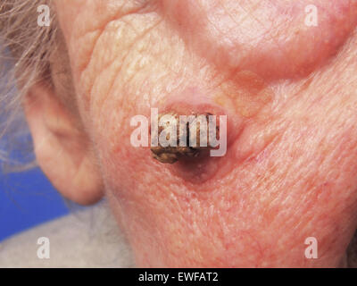 SQUAMOUS CELL CARCINOMA Stock Photo