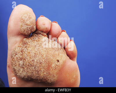 PLANTAR WART Stock Photo