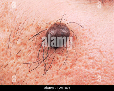 INTRADERMAL NEVUS Stock Photo