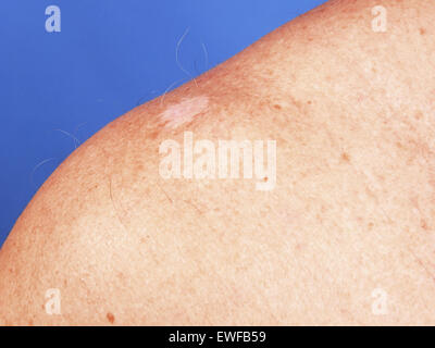 Skin cancer Nodular basal cell carcinoma (BCC) on the chest Stock Photo ...