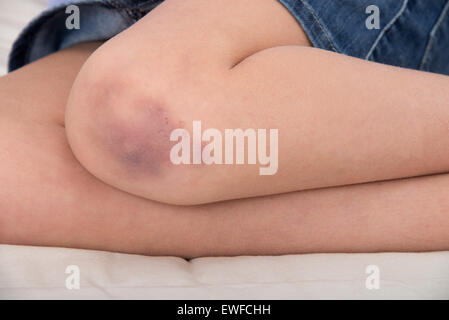 CHILD WITH HEMATOMA Stock Photo