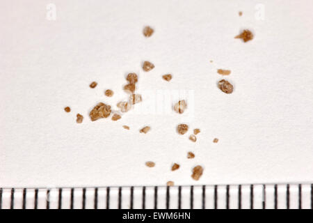 fragments of a kidney stone broken up by extracorporeal shock wave lithotripsy with a mm measuring scale Stock Photo