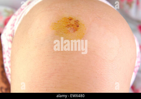 Flesh wound Scab on knee and scar because of falling Stock Photo - Alamy