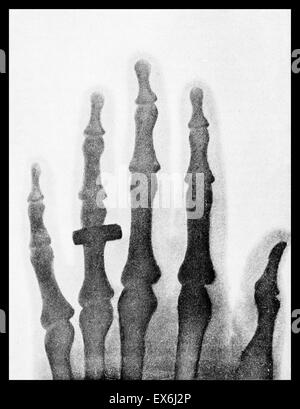 The hand of Mrs. Wilhelm Roentgen: the first X-ray image, 1895 Stock ...