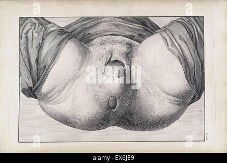 Illustration from 'A sett of anatomical tables, with explanations, and an abridgment, of the practice of midwifery'. (London: 1754). By William Smellie (1697 – 1763) a Scottish obstetrician Stock Photo