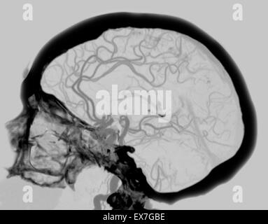 Angiogram CT showing the blood supply of the brain, including the Circle of Willis. Stock Photo