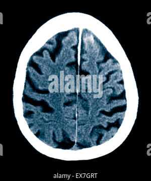 CT scan of an 84 year old man with Alzheimer's disease. CT shows brain ...