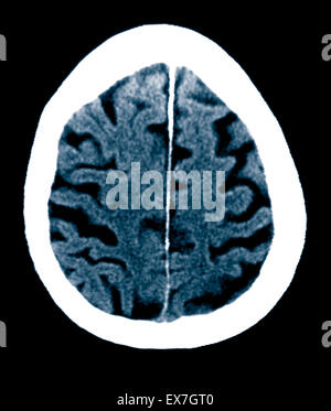 CT scan of an 84 year old man with Alzheimer's disease. CT shows brain ...